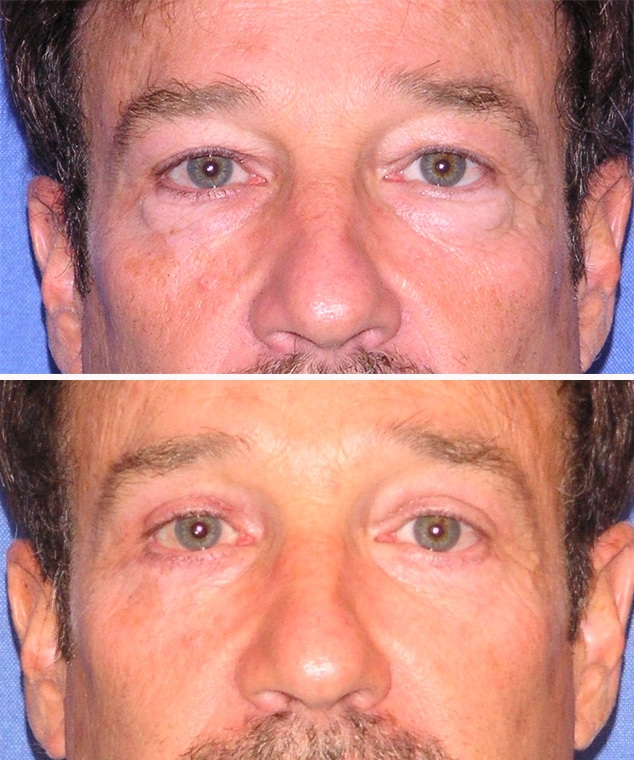 blepharoplasty before and after patient