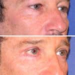 Thumbnail of http://blepharoplasty%20before%20and%20after%20patient