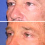 Thumbnail of http://blepharoplasty%20before%20and%20after%20patient