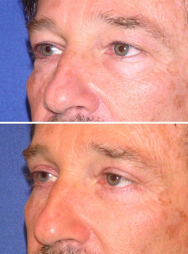 blepharoplasty before and after patient