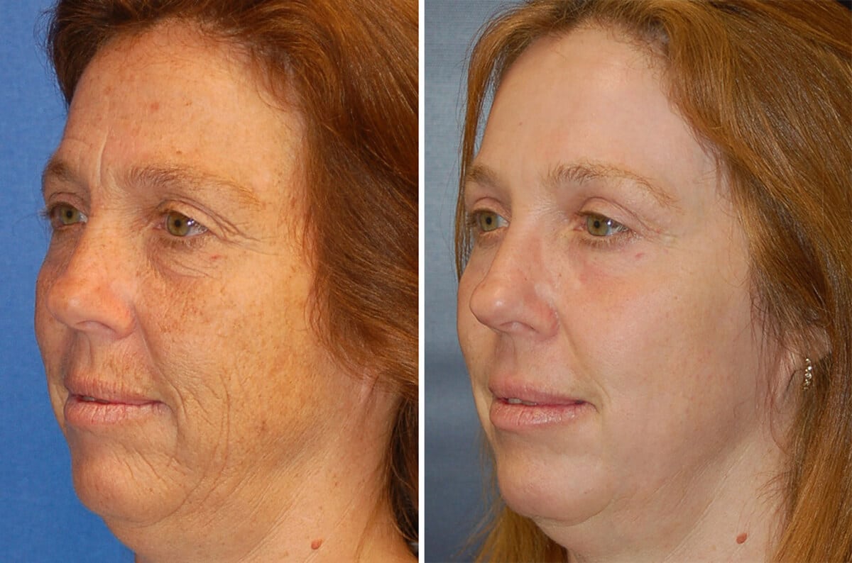 snyder erbium laser resurfacing before and after patient photo