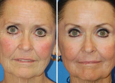 Erbium Laser Skin Resurfacing Patient – 2