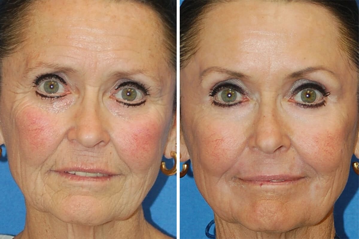 snyder erbium laser resurfacing before and after patient photo