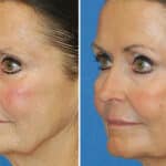 Thumbnail of http://snyder%20erbium%20laser%20resurfacing%20before%20and%20after%20patient%20photo