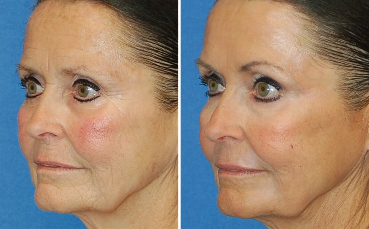 snyder erbium laser resurfacing before and after patient photo