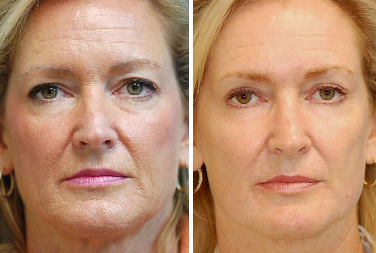 snyder erbium laser resurfacing before and after patient photo