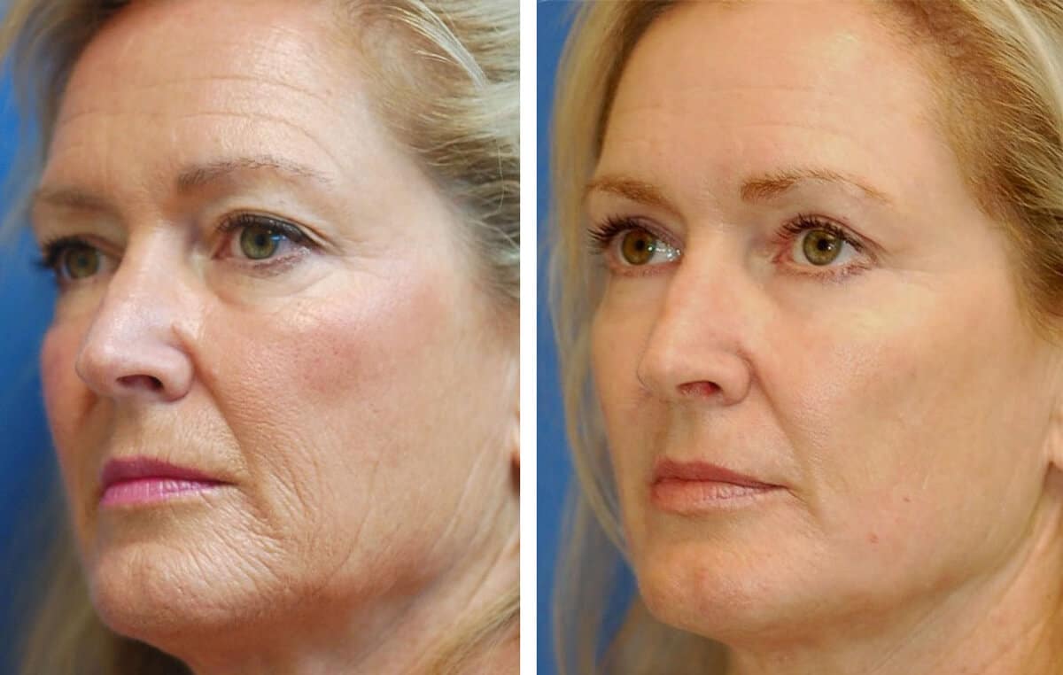 snyder erbium laser resurfacing before and after patient photo