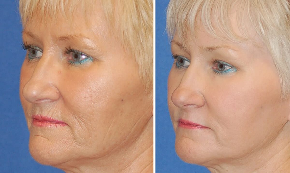 snyder erbium laser resurfacing before and after patient photo