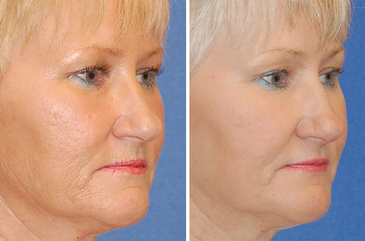 snyder erbium laser resurfacing before and after patient photo