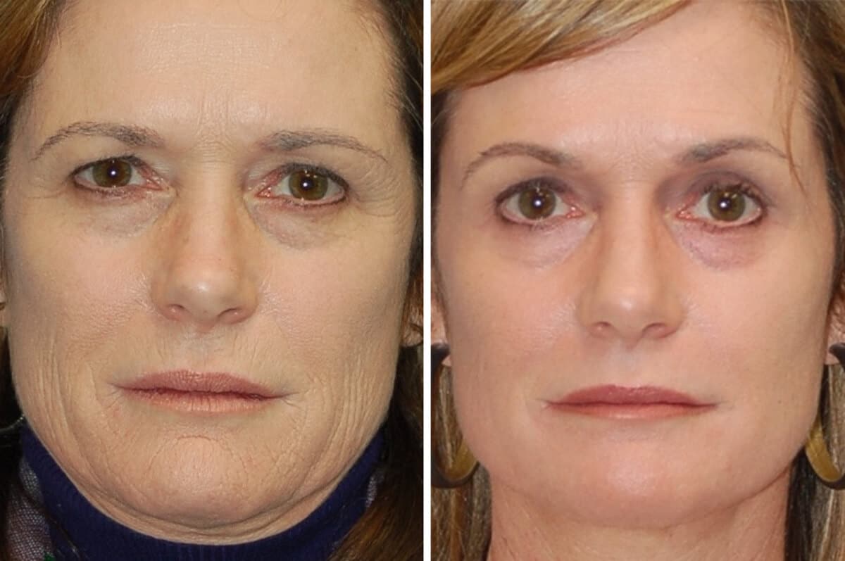 snyder erbium laser resurfacing before and after patient photo