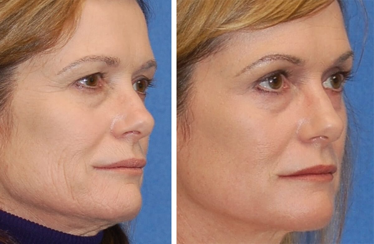 snyder erbium laser resurfacing before and after patient photo