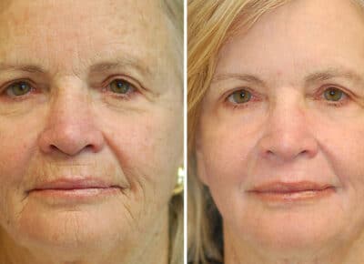 Erbium Laser Skin Resurfacing Patient – 6