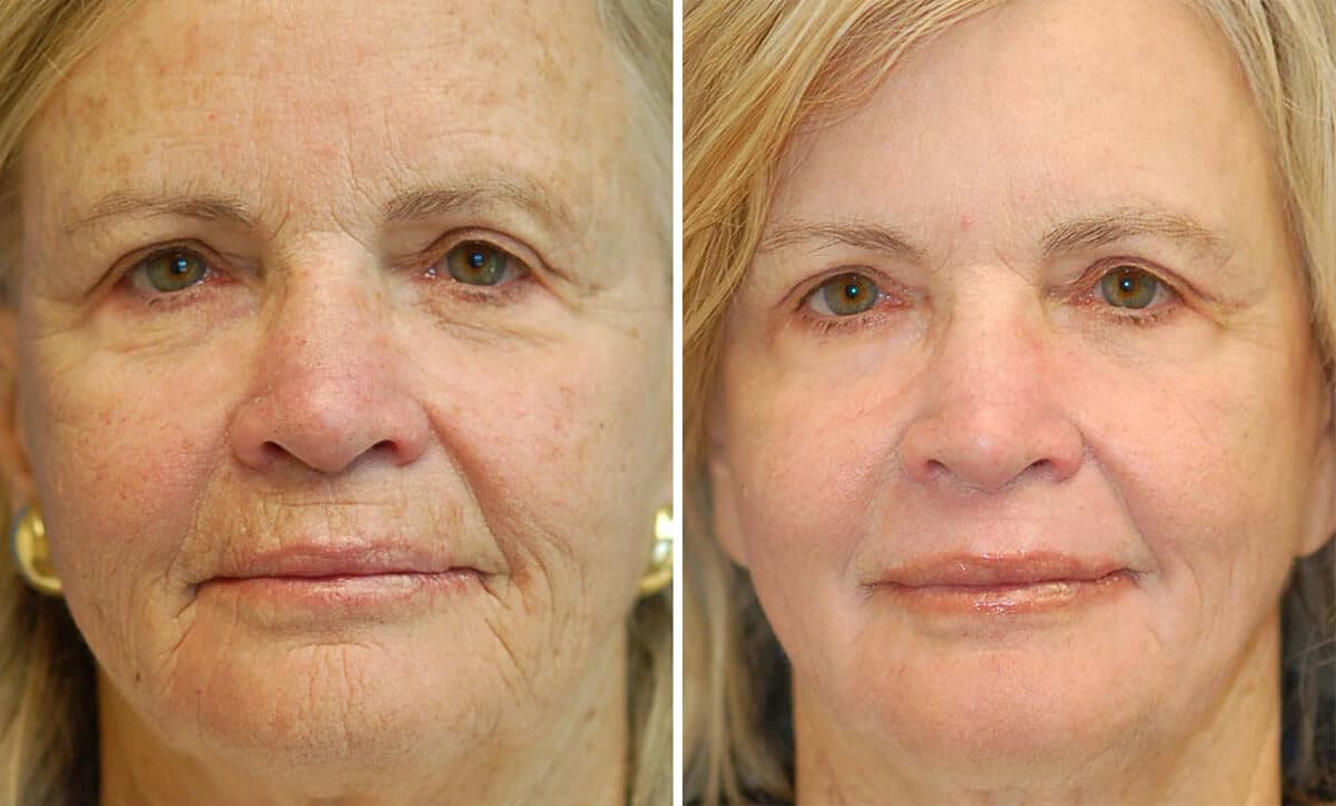 snyder erbium laser resurfacing before and after patient photo