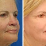 Thumbnail of http://snyder%20erbium%20laser%20resurfacing%20before%20and%20after%20patient%20photo