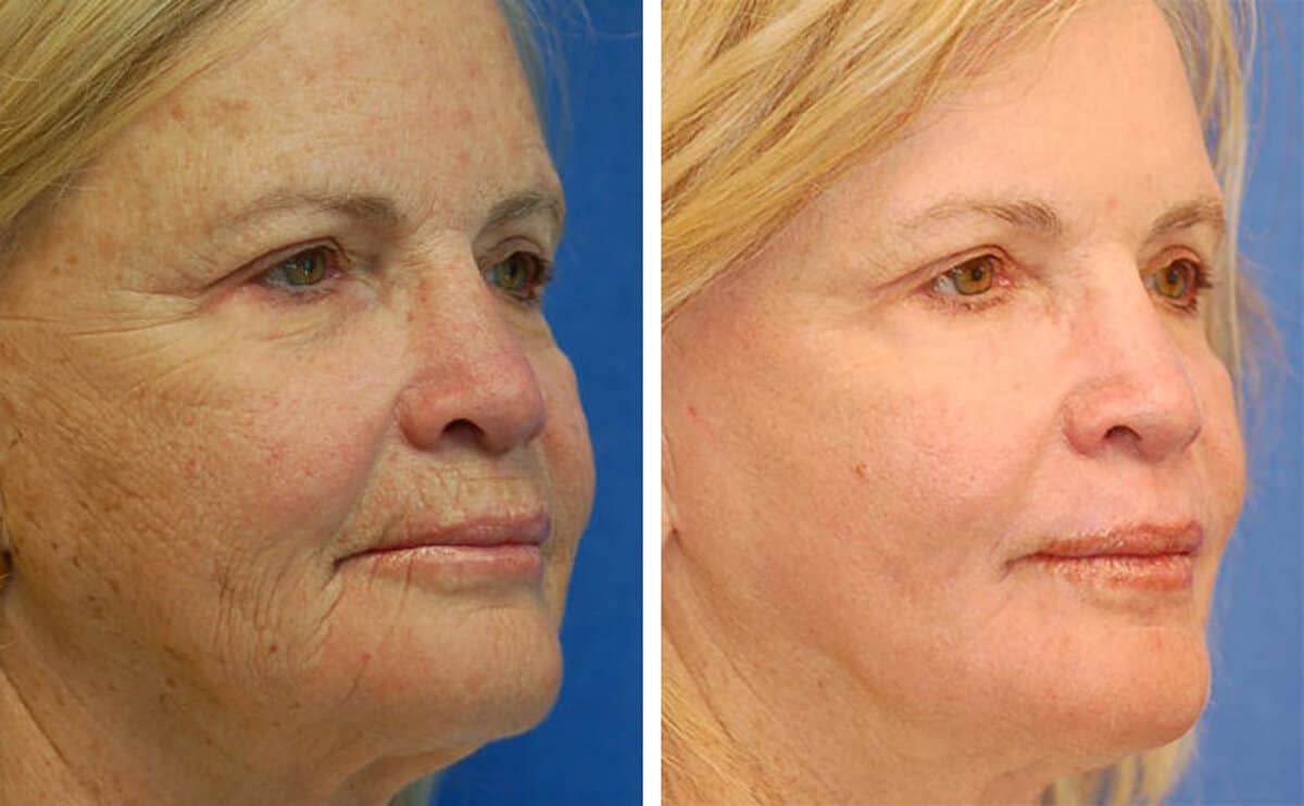 snyder erbium laser resurfacing before and after patient photo