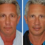 Thumbnail of http://snyder%20facelift%20patient%20before%20and%20after%20photo