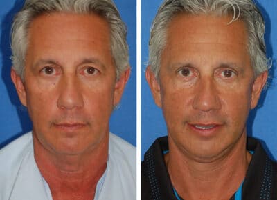 Facelift Patient – 2