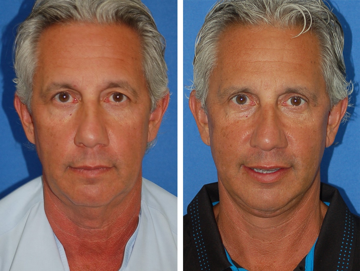 snyder facelift patient before and after photo