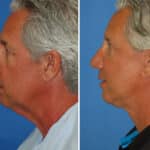 Thumbnail of http://snyder%20facelift%20patient%20before%20and%20after%20photo