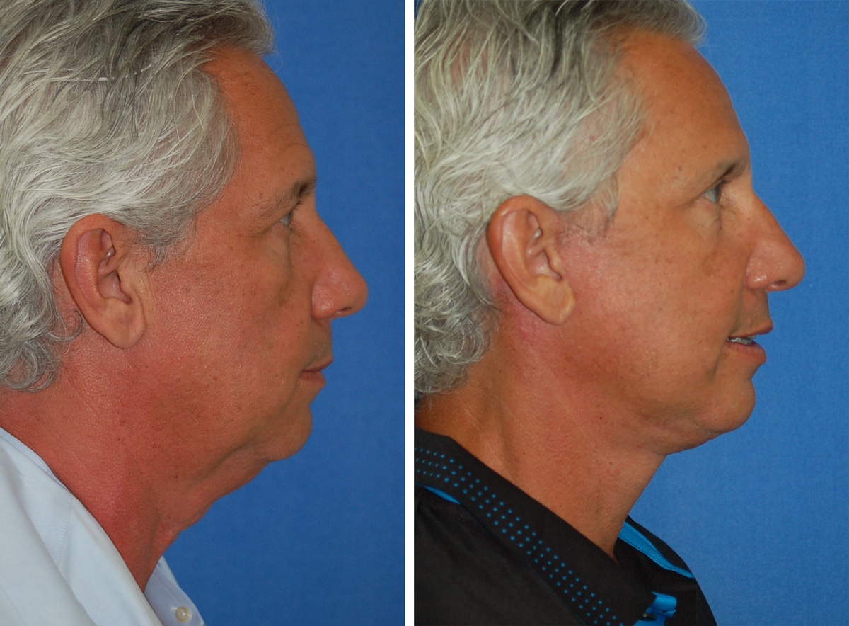 snyder facelift patient before and after photo