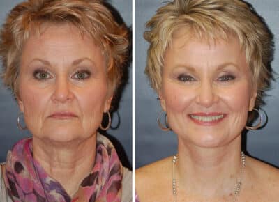 Facelift Patient