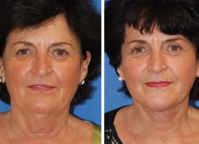 Facelift Patient – 5