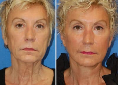 Facelift Patient – 3