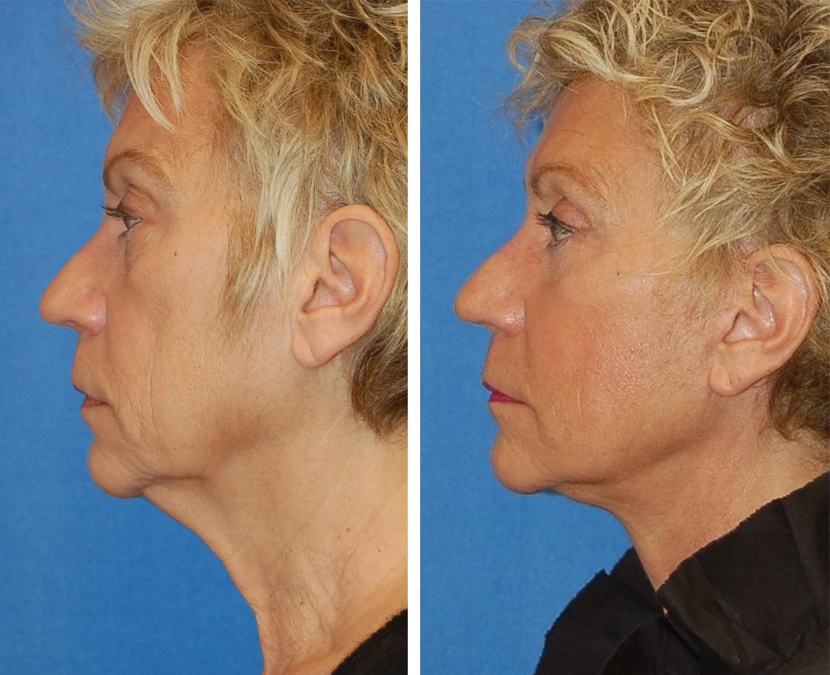 snyder facelift patient before and after photo