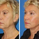 Thumbnail of http://snyder%20facelift%20patient%20before%20and%20after%20photo