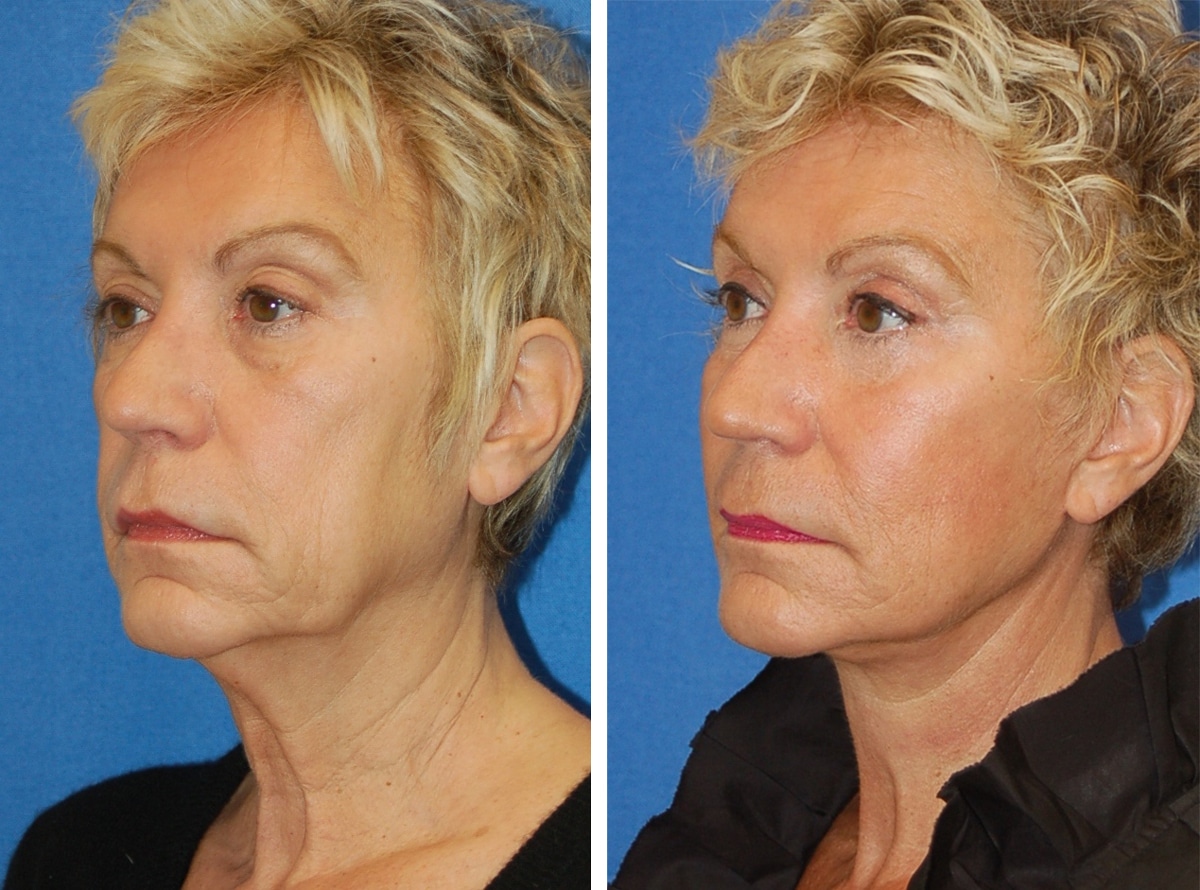 snyder facelift patient before and after photo