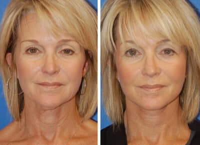 Facelift Patient – 4