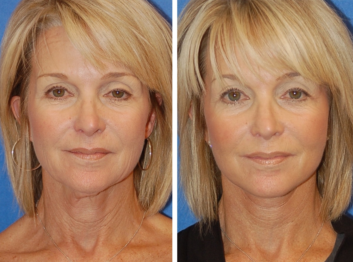 snyder facelift patient before and after photo