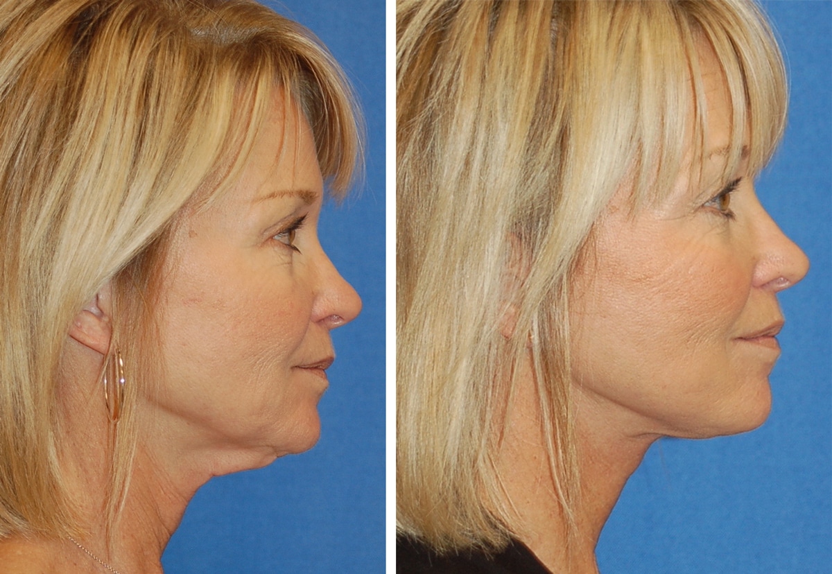 snyder facelift patient before and after photo