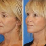 Thumbnail of http://snyder%20facelift%20patient%20before%20and%20after%20photo