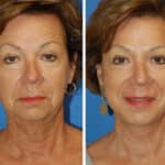 Thumbnail of http://snyder%20facelift%20patient%20before%20and%20after%20photo