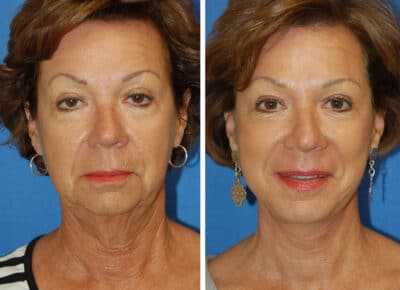 Facelift Patient – 6