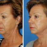 Thumbnail of http://snyder%20facelift%20patient%20before%20and%20after%20photo