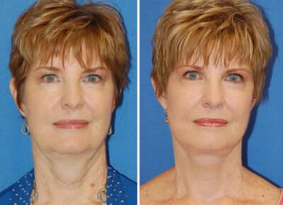 Facelift Patient – 7