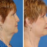 Thumbnail of http://snyder%20facelift%20patient%20before%20and%20after%20photo