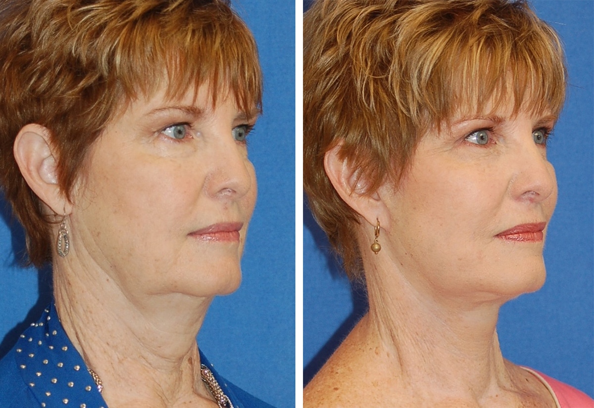 snyder facelift patient before and after photo