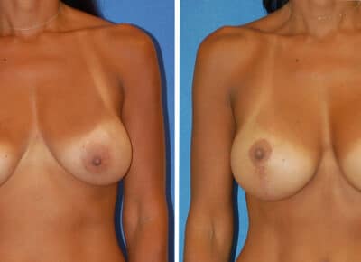Breast Lift with Implants Patient – 2