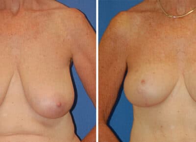 Breast Procedure Patient – 7