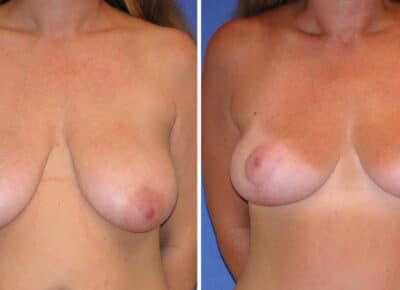 Breast Procedure Patient – 8