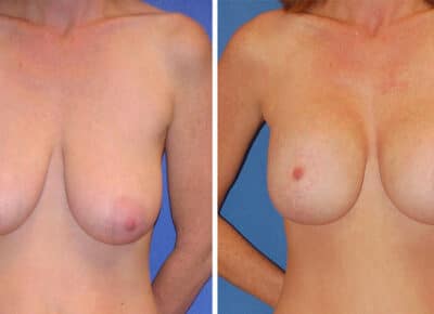Breast Lift with Implants Patient – 3