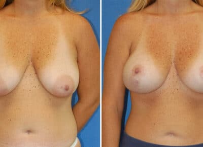Breast Lift with Implants Patient – 4