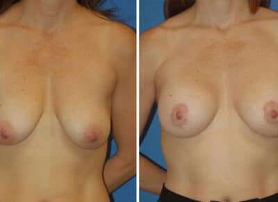 Breast Lift with Implants Patient – 9
