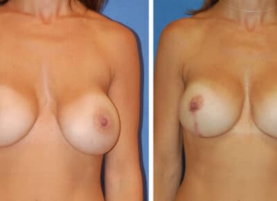 Breast Lift with Implants Patient – 5