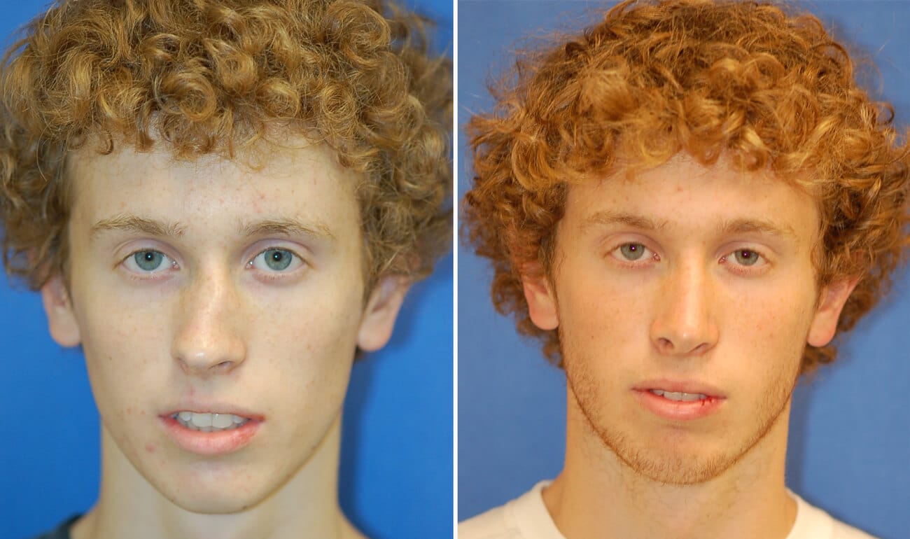 rhinoplasty patient before and after