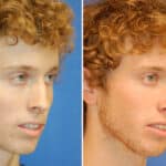 Thumbnail of http://rhinoplasty%20patient%20before%20and%20after