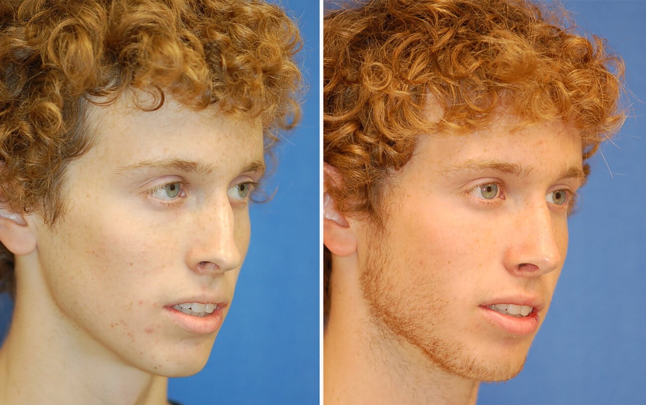 rhinoplasty patient before and after